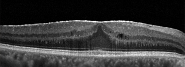 Epiretinal Memran