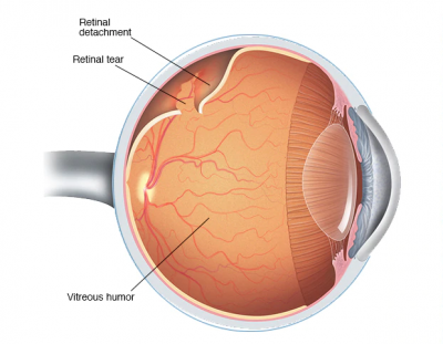 Retina Dekolmanı