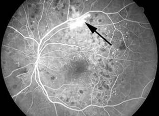 Fundus Floresein Anjiyografi (FFA)