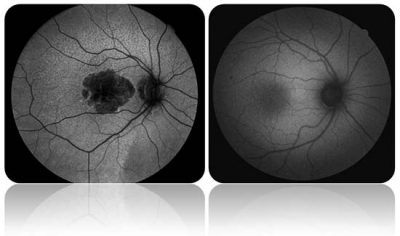 Fundus Otofloresansı